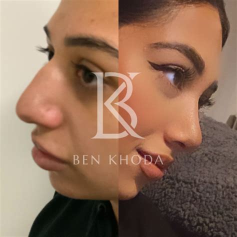 Rhinoplasty Marylebone London Nose Job Dr Ben Khoda