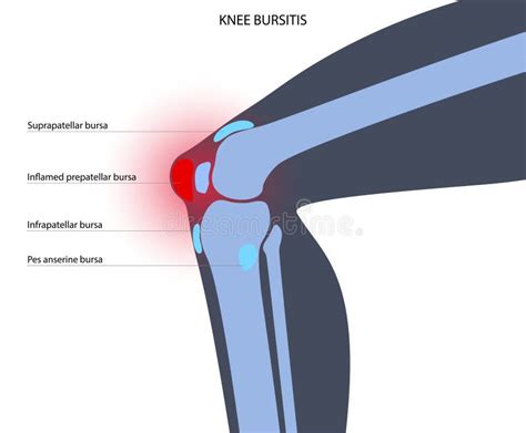 Concepto De Inflamación De Bursitis Ilustración del Vector