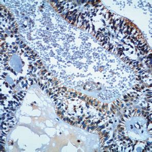 Immunoexpression Of MMP 1 In Neoplastic Cells Of Ameloblastoma