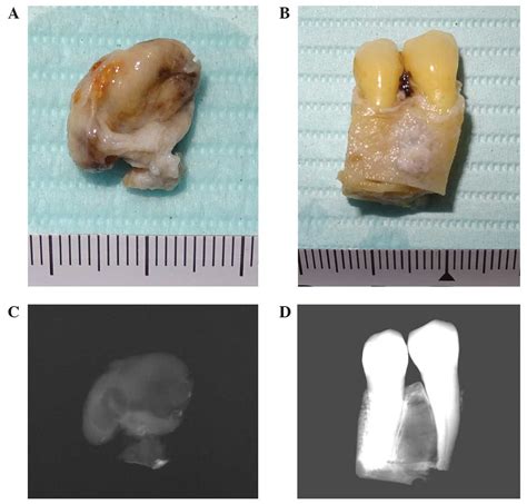 Simultaneous Occurrence Of Keratocystic Odontogenic Tumor And