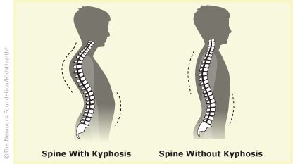 Kyphosis Factsheet (for Schools) (for Parents) - Rady Children's ...