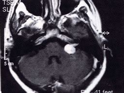 Neurinoma Del Nervo Acustico Orl