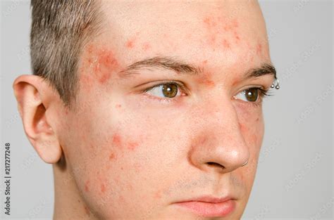 Portrait Of Young Guy With Allergy With Redness Face Close Up Stock