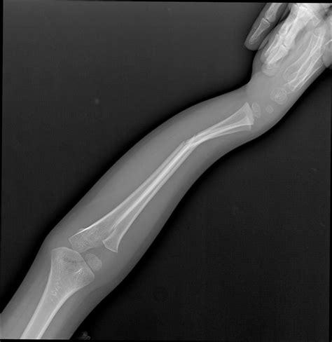 Radius And Ulnar Shaft Fractures Image Radiopaedia Org