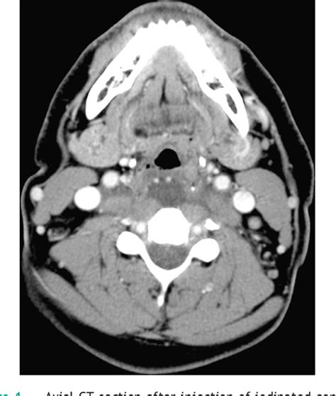 Figure From Calcific Retropharyngeal Tendinitis Of The Longus Colli