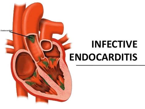 Infective Endocarditis Paediatrics