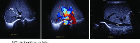 Liver Ultrasound A Transverse View Showing Umbilical Venous Catheter