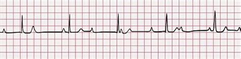 AV block: 3rd degree (complete heart block) • LITFL