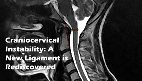 Ci The Anterior Atlanto Occipital Ligament