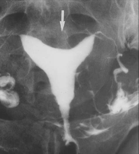 Arcuate Uterus In 30 Year Old Woman Hysterosalpingogram With Normal