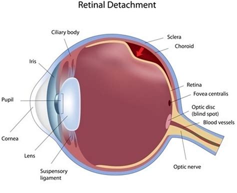 Retinal Detachment Causes Signs Symptoms Surgery Repair