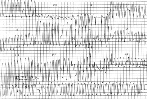 Pre-excitation syndromes • LITFL • ECG Library Diagnosis