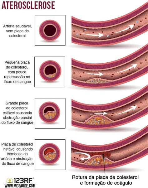 Infarto Do MiocÁrdio Causas E Prevenção Md Saúde