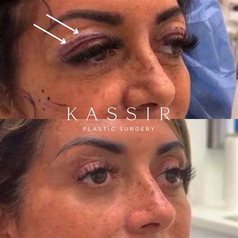 Brow Lift Nyc Vs Upper Blepharoplasty Nyc Understanding The Difference