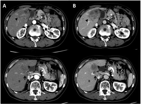 Contrast Enhanced Computed Tomography Cect Scan For Initial