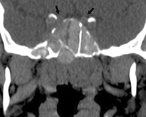 Multiplanar Sinus Ct A Systematic Approach To Imaging Before Functional Endoscopic Sinus