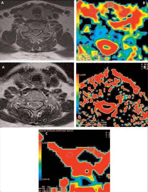 Figure 2 From The Role Of Diffusion Weighted Mr Imaging For Differentiation Between Graves