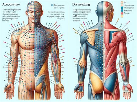 Differences Between Dry Needling Vs Acupuncture