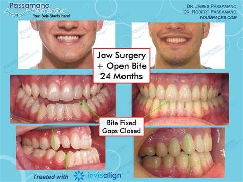 Underbite Jaw Surgery With Open Bite Passamano Orthodontics