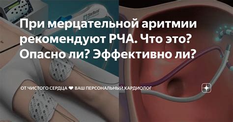 При мерцательной аритмии рекомендуют РЧА. Что это? Опасно ли ...