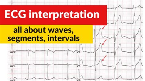 Basics Of Ecg Interpretation Of Waves And Intervals Epomedicine Porn Sex Picture