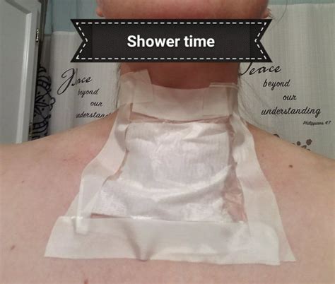 Life After Thyroidectomy Parathyroidectomy Photos Artofit