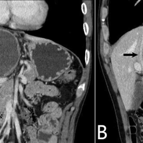 A B On Contrast Enhanced Coronal And Sagittal Computed Tomography