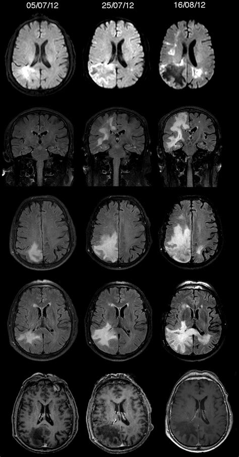 Histolog A De La Leucoencefalopat A Multifocal Progresiva