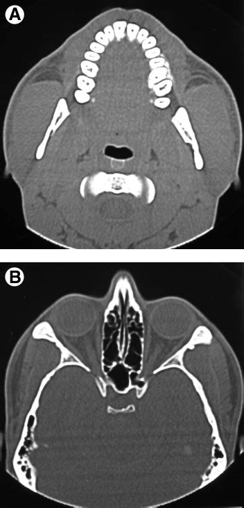 Masseteric Hypertrophy Considerations Regarding Treatment Planning Decisions And Introduction