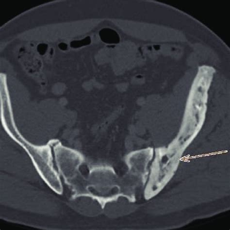 Axial Computed Tomography Of The Pelvis Showing Left Ilium Cortical