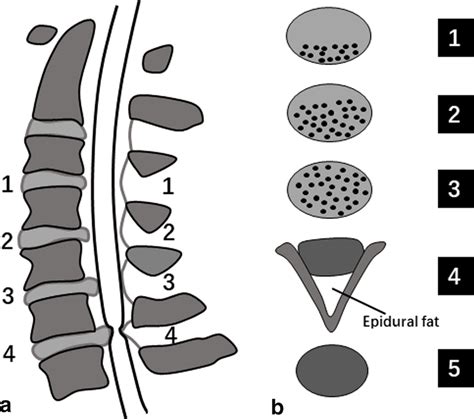 Schematic Diagrams Of Grading System Of Cervical Canal Stenosis A And