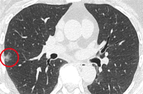 Penn Medicine Study Reveals Imaging Approach with Potential to Detect ...