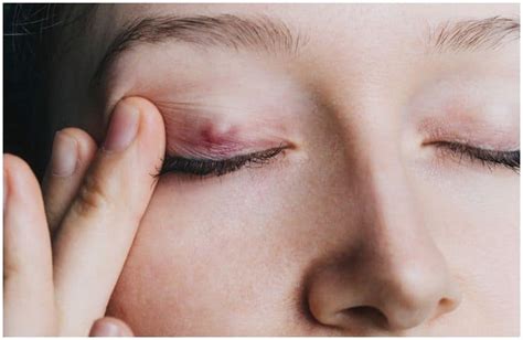 Chalazion vs Stye (Hordeolum) - Your Health Remedy