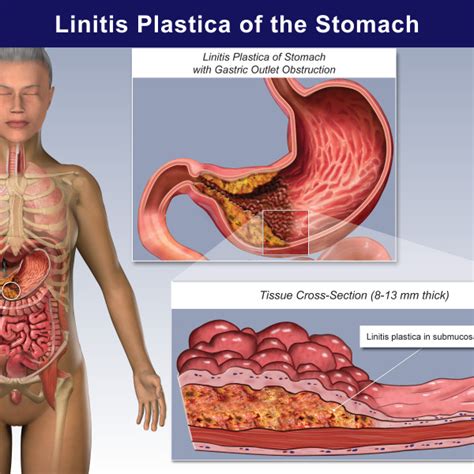 Anatomy Of Esophagus And Stomach Trial Exhibits Inc