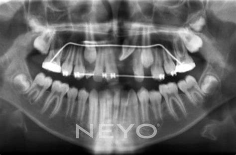 Impacted Teeth Neyo Dental West Sussex Dental Clinic