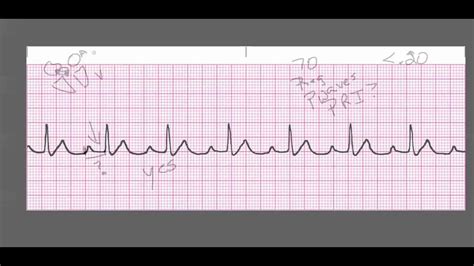 1st Degree Heart Block Youtube