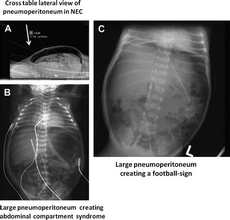 A Clinical Perspective Of Necrotizing Enterocolitis Clinics In