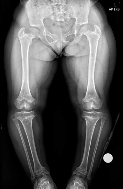 Achondroplasia X Ray Vs Normal