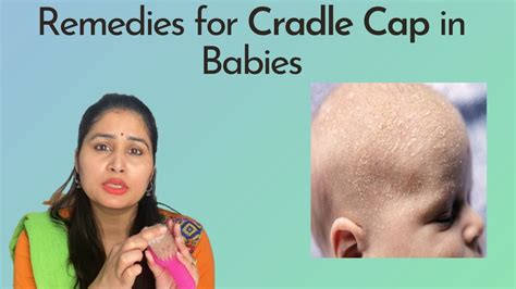 बच्चों में Cradle Cap कैसे ठीक क़रे Home Treatment For Cradle Cap