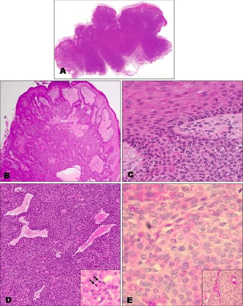 A A Single Pedunculated Large Tumor Mass And Well Circumscribed Tumor