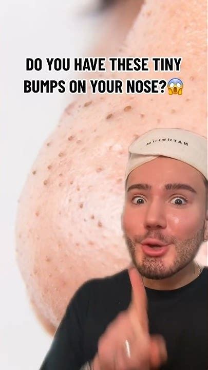 How To Get Rid Of Tiny Bumps On Your Nose 😱 Follow For More 💗 Beauty Skincare Skin Acne