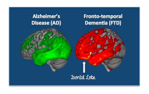 Fronto Temporal Dementia Where Age Is Just A Number In 2021 Dementia