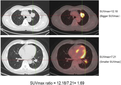 SUVmax Ratio On PET CT May Differentiate Between Lung Metastases And