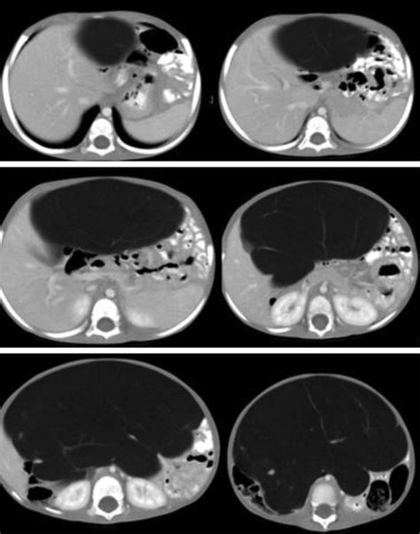 Ct Of Abdomen Revealed 20 × 10 × 10 Cm A Well Encapsulated Fatty Mass Download Scientific