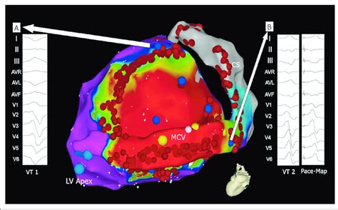 Electroanatomical Bipolar Voltage Map Of A Left Ventricle The Coronary