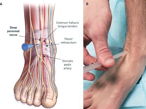 Nerve Blocks Part Ii Lower Extremity Aafp