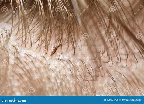 Dead Lice On A Comb Stock Image Cartoondealer