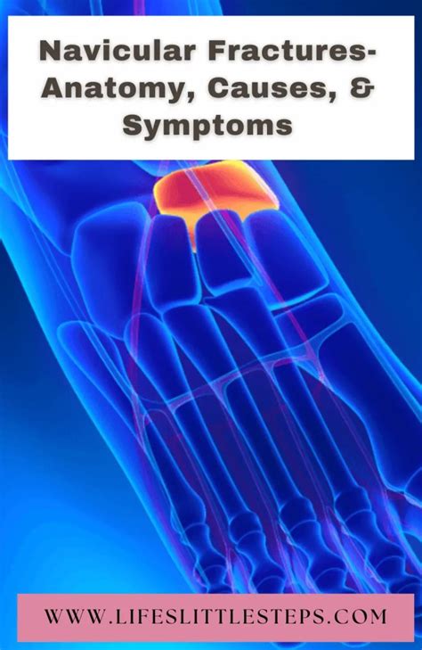 Navicular Fractures- Anatomy, Causes, & Symptoms