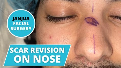 Scar Revision On Nose Dr Tanveer Janjua New Jersey Youtube