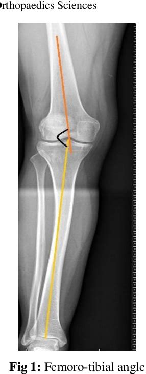 Figure From Effect Of Proximal Fibular Osteotomy In Medial